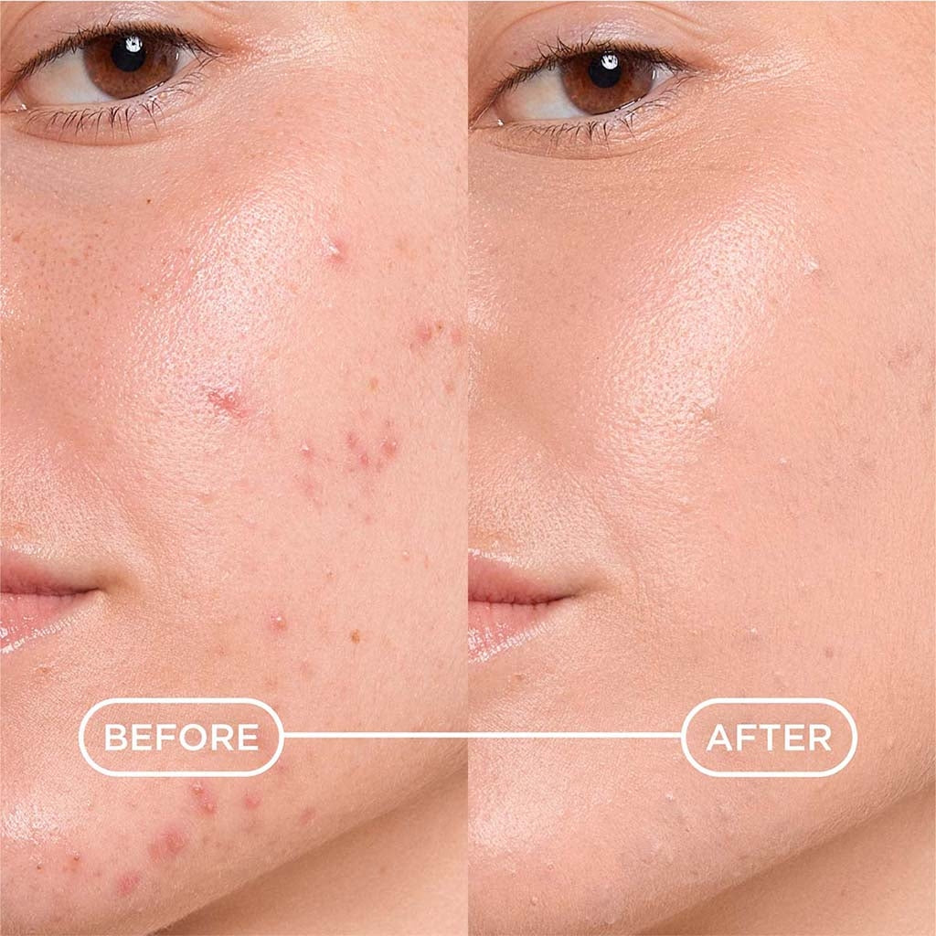 Bioderma Sébium, before and after photos of the cheek