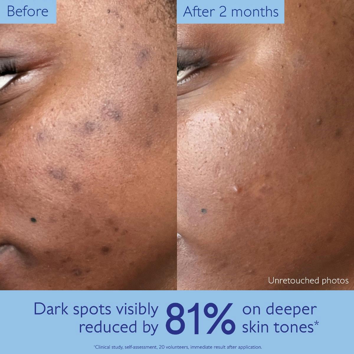 Caudalie Vinoperfect, before and after photos of a cheek on deeper skin