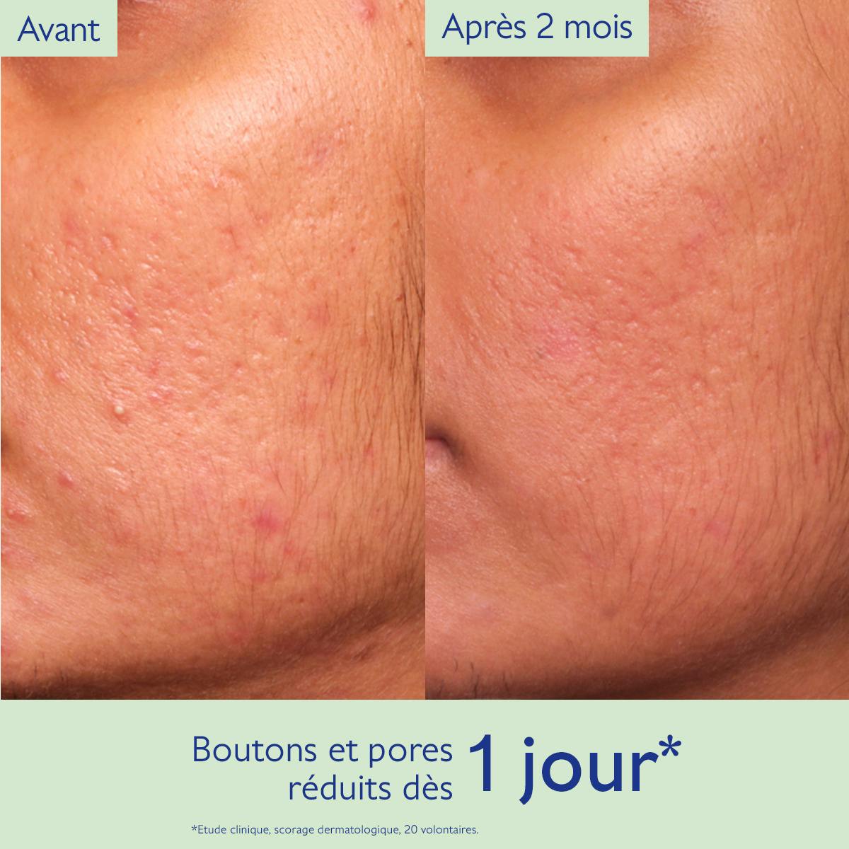 Caudalie Vinopure, before and after photos of the cheek