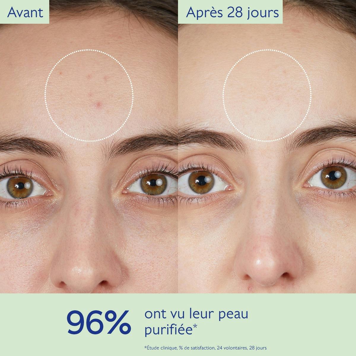 Caudalie Vinopure, before and after photos of the forehead