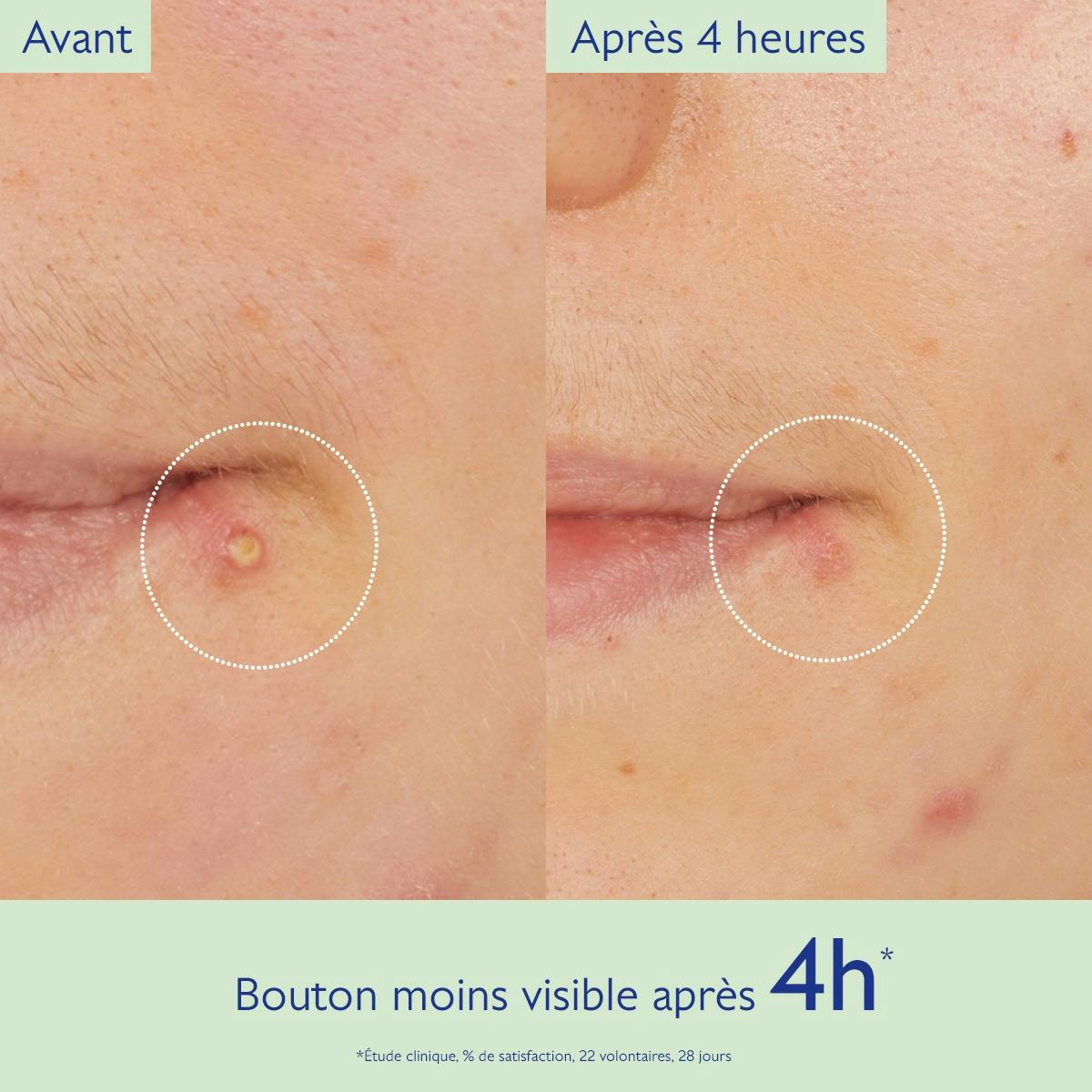Caudalie Vinopure, before and after photos of the skin below the lip