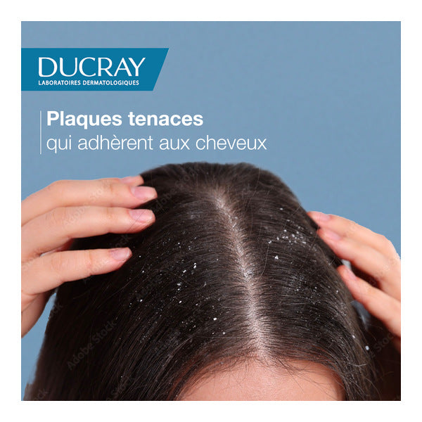 Ducray Squanorm, hands on a scalp with visible flakes, text in French