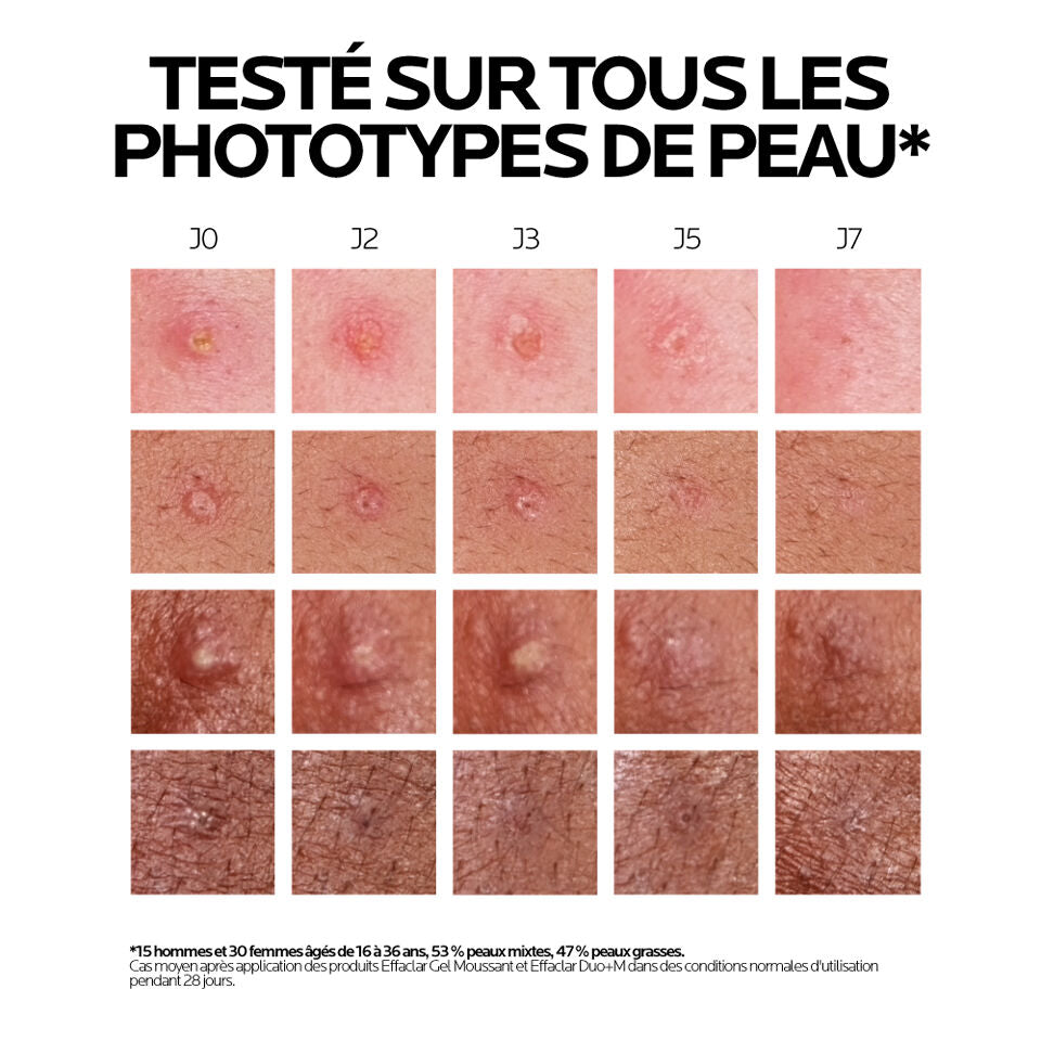 La Roche-Posay Effaclar, before and after photos on four skin tones