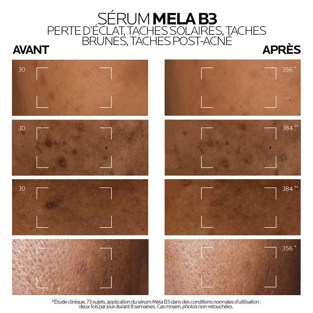 La Roche-Posay Mela B3, before and after photos of four skin areas