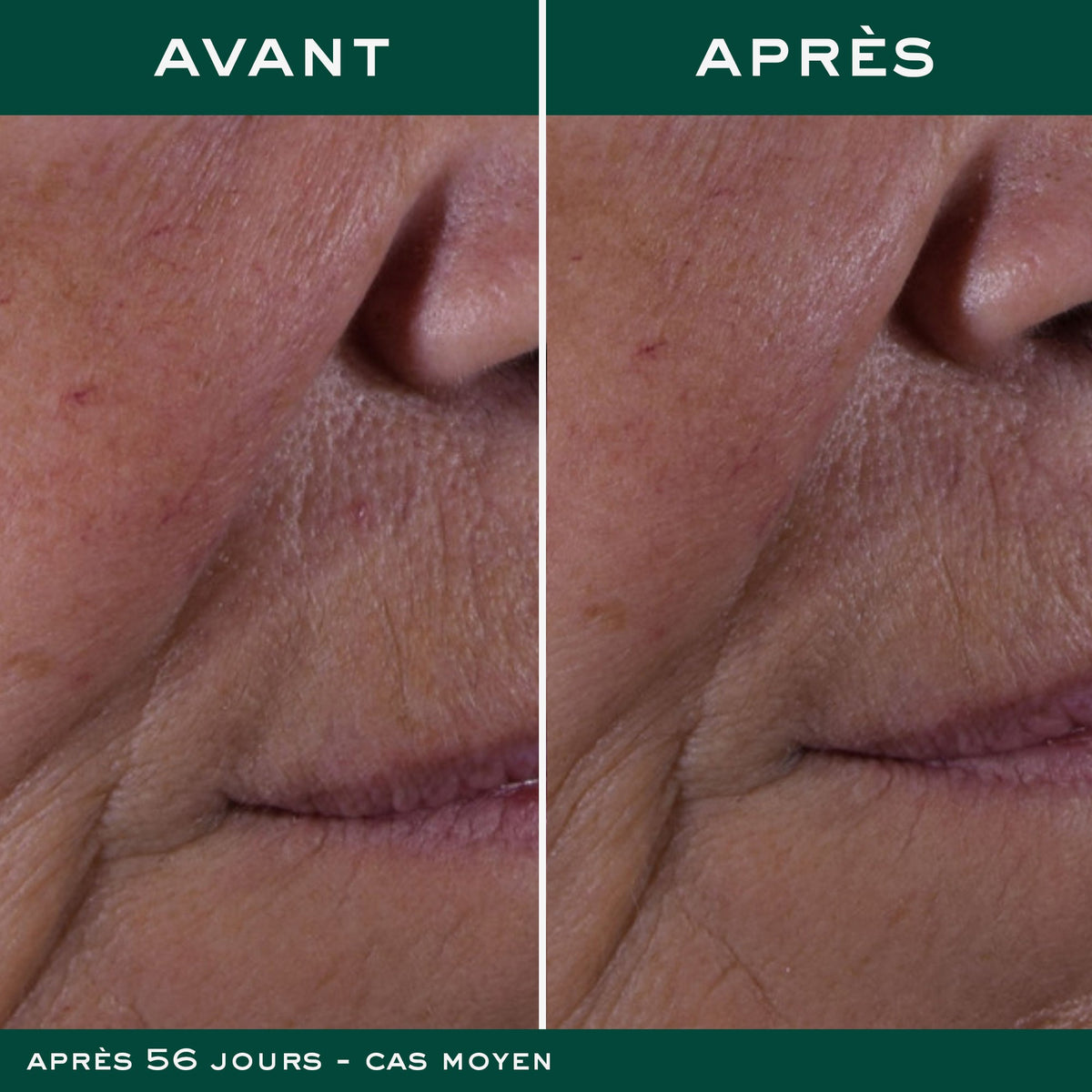 NUXE NUXURIANCE ULTRA, before and after photos of the cheek and mouth area