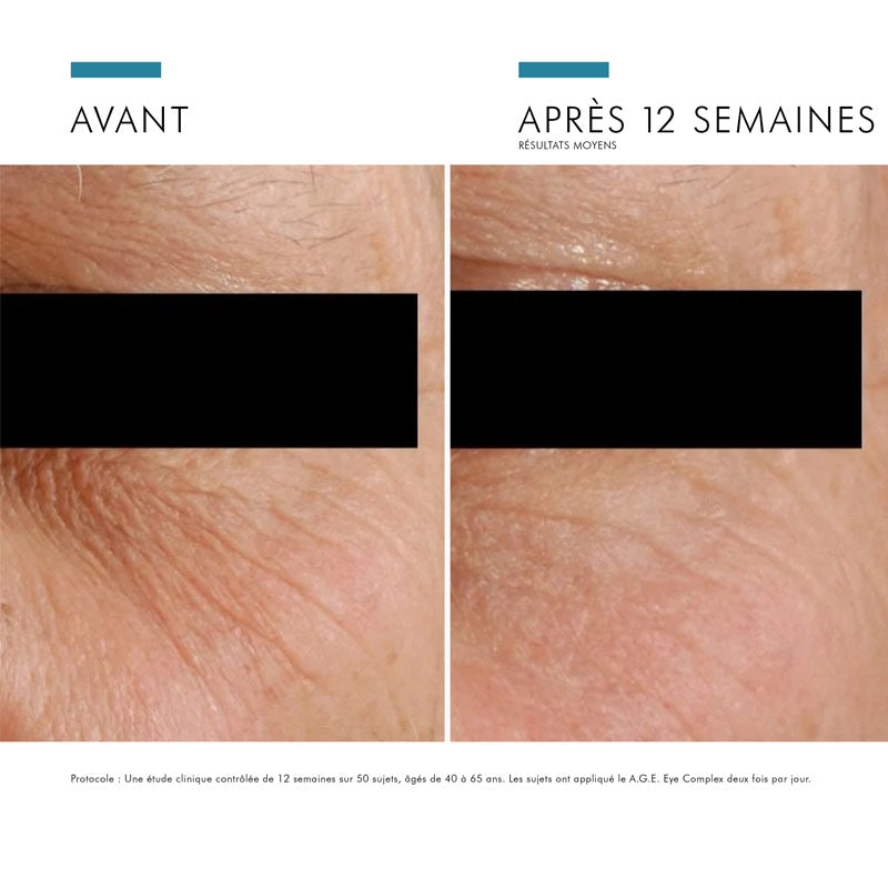 SkinCeuticals Age Eye Complex, before and after photos of the eye area