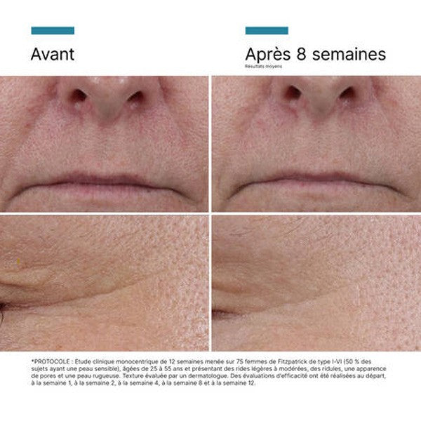 SkinCeuticals P-Tiox, before and after photos of the mouth and eye area