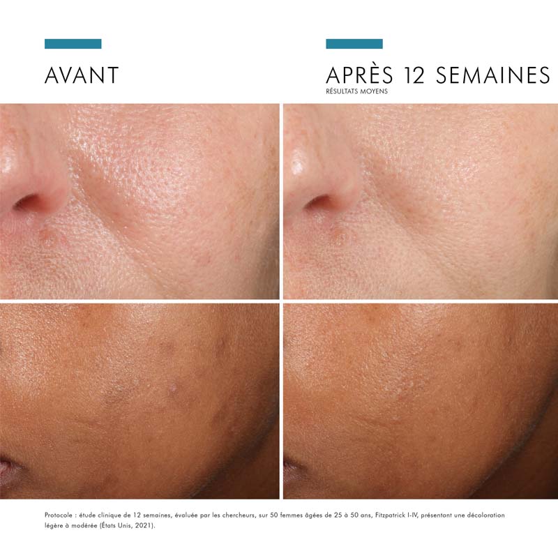 SkinCeuticals Phloretin CF, before and after photos of the cheek on two skin tones