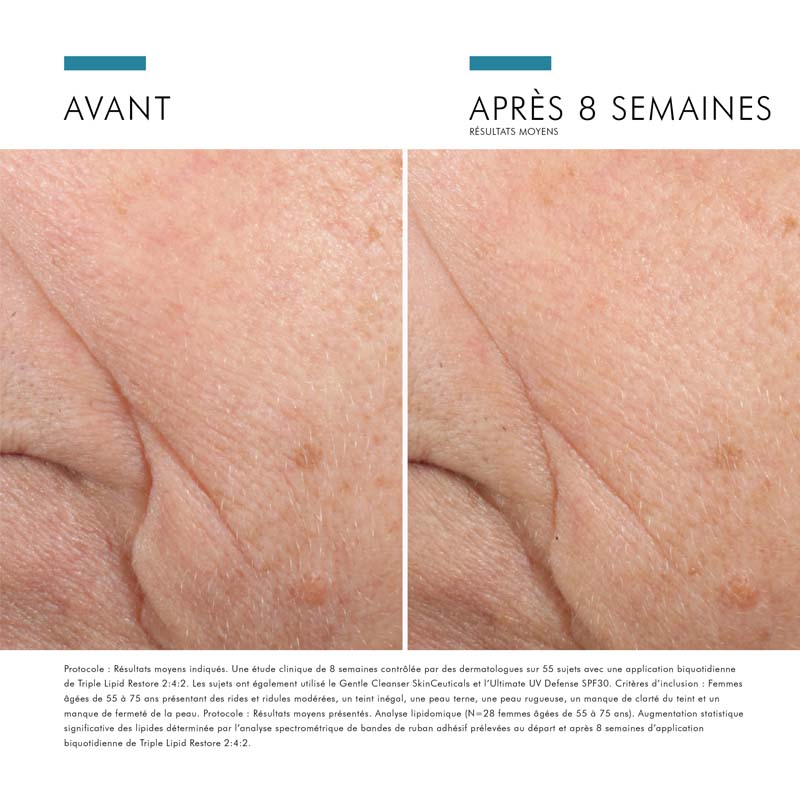 SkinCeuticals Triple Lipid Restore 2:4:2, before and after photos of the cheek